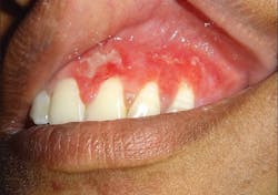 Bacterial origin tuberculosis Bacterial origin tuberculosis