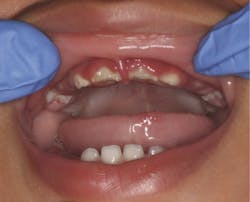 Primary herpetic gingivostomatitis Primary herpetic gingivostomatitis