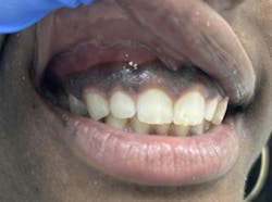 Melanoplakia Melanoplakia