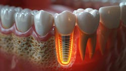 Dental implants and fluoride Dental implants and fluoride