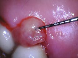 Figures 1-3: Examination of the soft tissue specimen reveals keratinized stratified squamous epithelium overlying a mass of inflamed and vascular fibrous connective tissue. The bulk of the specimen is devoid of any surface epithelium and replaced by a fibrinous exudate intermixed with necrotic inflammatory cells. The epithelium where intact appears hyperplastic and displays changes secondary to inflammation. The underlying fibrous connective tissue mass, which forms the bulk of the specimen, is composed of loose to dense collagen bundles interspersed by numerous endothelial lined capillaries, proliferative endothelial cells, and an intense inflammatory cell infiltrate consisting of lymphocytes, plasma cells, and neutrophils. Figures 1-3: Examination of the soft tissue specimen reveals keratinized stratified squamous epithelium overlying a mass of inflamed and vascular fibrous connective tissue. The bulk of the specimen is devoid of any surface epithelium and replaced by a fibrinous exudate intermixed with necrotic inflammatory cells. The epithelium where intact appears hyperplastic and displays changes secondary to inflammation. The underlying fibrous connective tissue mass, which forms the bulk of the specimen, is composed of loose to dense collagen bundles interspersed by numerous endothelial lined capillaries, proliferative endothelial cells, and an intense inflammatory cell infiltrate consisting of lymphocytes, plasma cells, and neutrophils.