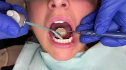 Tips for Working Around a Lingual Permanent Retainer Tips for Working Around a Lingual Permanent Retainer