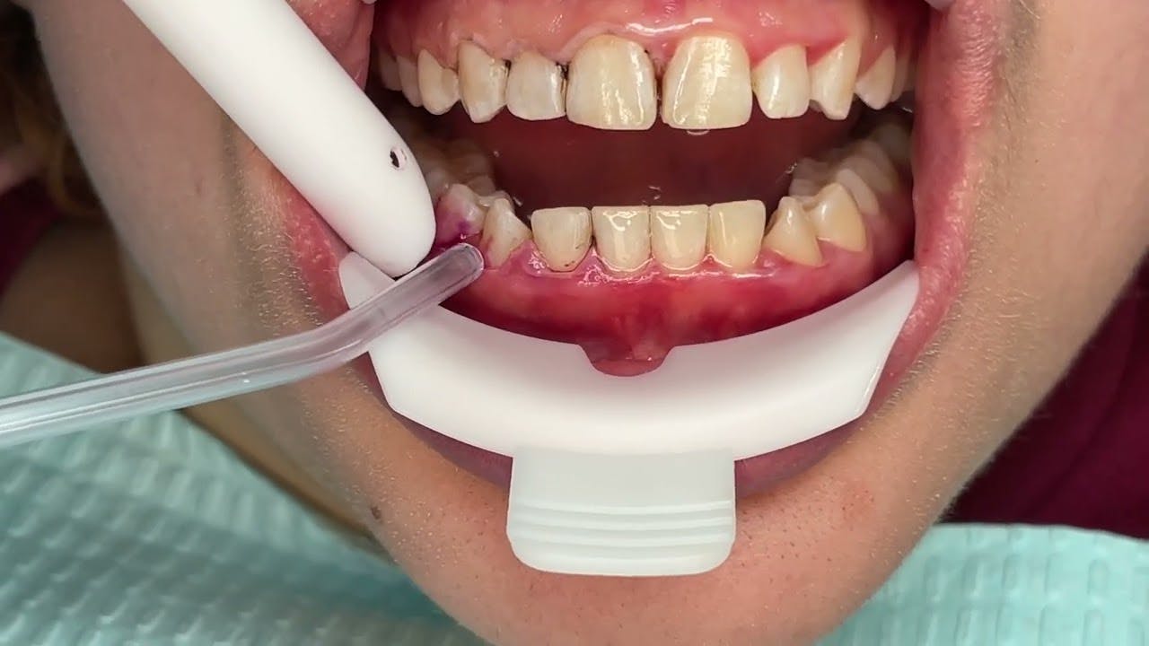 A new adjunct to periodontal therapy