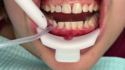 A new adjunct to periodontal therapy A new adjunct to periodontal therapy