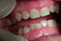 Bulging, bulbous, and boggy gingiva: A sign of more than just ...