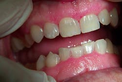 Figure 2: Gingival hyperplasia from diltiazem Figure 2: Gingival hyperplasia from diltiazem