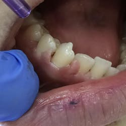 Figure 6: Fibromatous gingival enlargement from tuberous sclerosis Figure 6: Fibromatous gingival enlargement from tuberous sclerosis