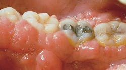 Figure 4: Cyclosporin-related hyperplasia Figure 4: Cyclosporin-related hyperplasia