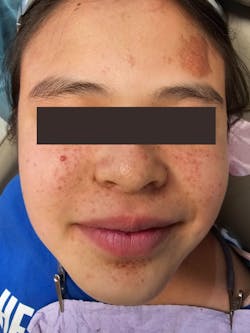 Figure 7: Facial angiofibromas and forehead plaque Figure 7: Facial angiofibromas and forehead plaque