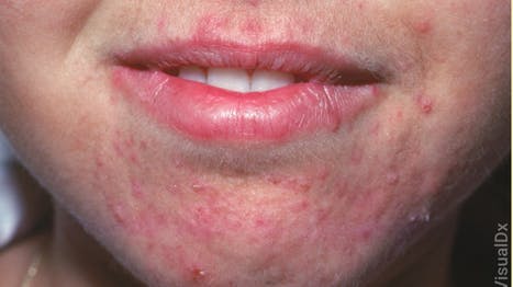 6734d5d6a9677079db3ceb00 Dermatitis