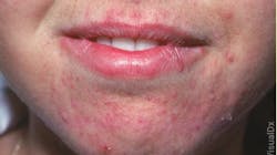 6734d5d6a9677079db3ceb00 Dermatitis 6734d5d6a9677079db3ceb00 Dermatitis