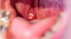 tonsil_stones tonsil_stones