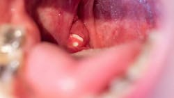 6760646f694f6d4c47513eb2 Tonsil Stones 6760646f694f6d4c47513eb2 Tonsil Stones