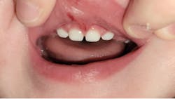 A photo (one week postaccident) of the author’s son’s lip-tie that was accidentally severed and then grew back on its own A photo (one week postaccident) of the author’s son’s lip-tie that was accidentally severed and then grew back on its own