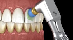 dental-polishing dental-polishing
