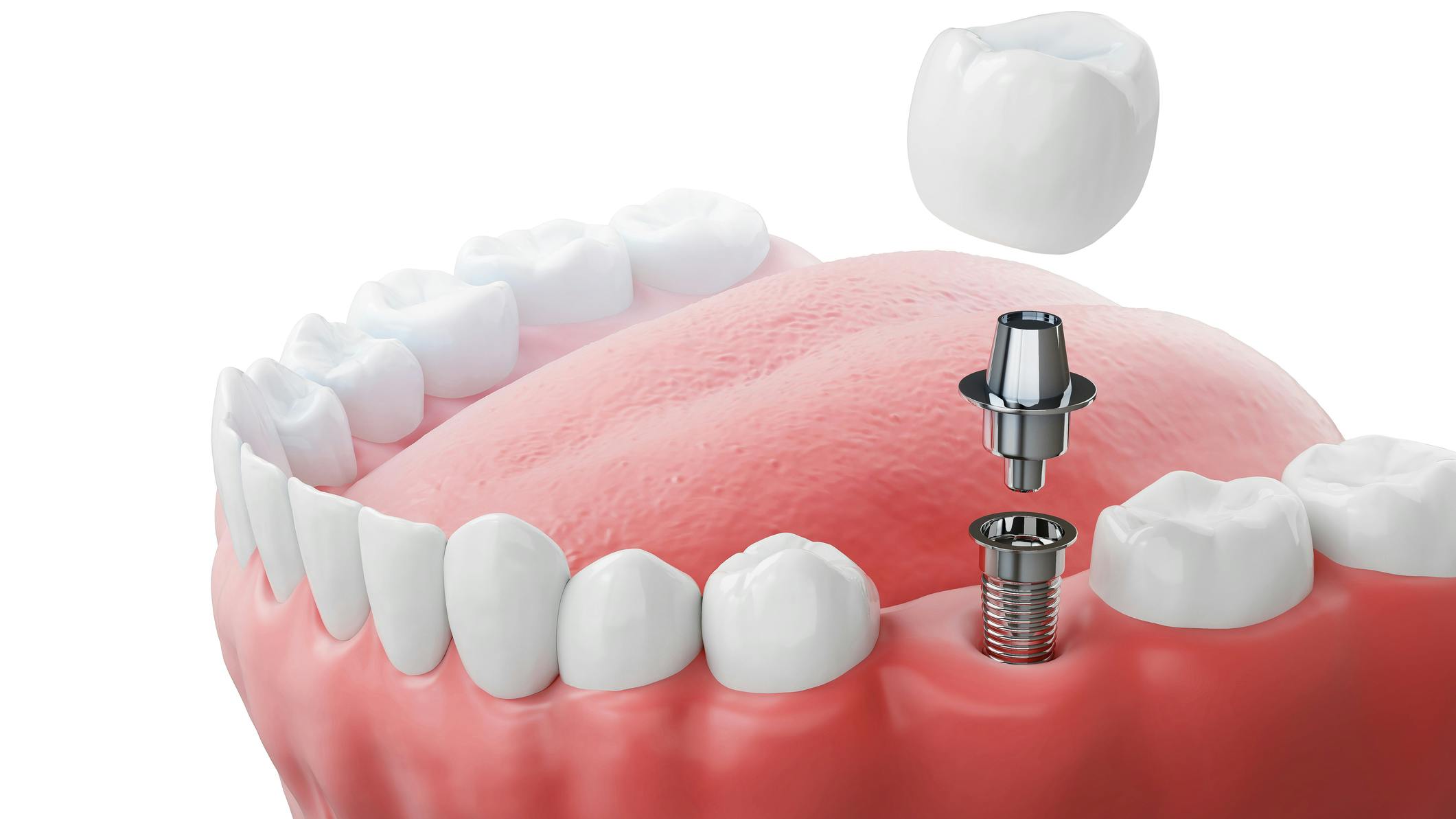 dental_implant_maintenance