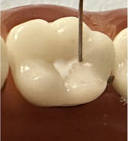 Figure 3: Voco’s sealant (Grandio Seal) being spread on occlusal surface without using an explorer tip Figure 3: Voco’s sealant (Grandio Seal) being spread on occlusal surface without using an explorer tip