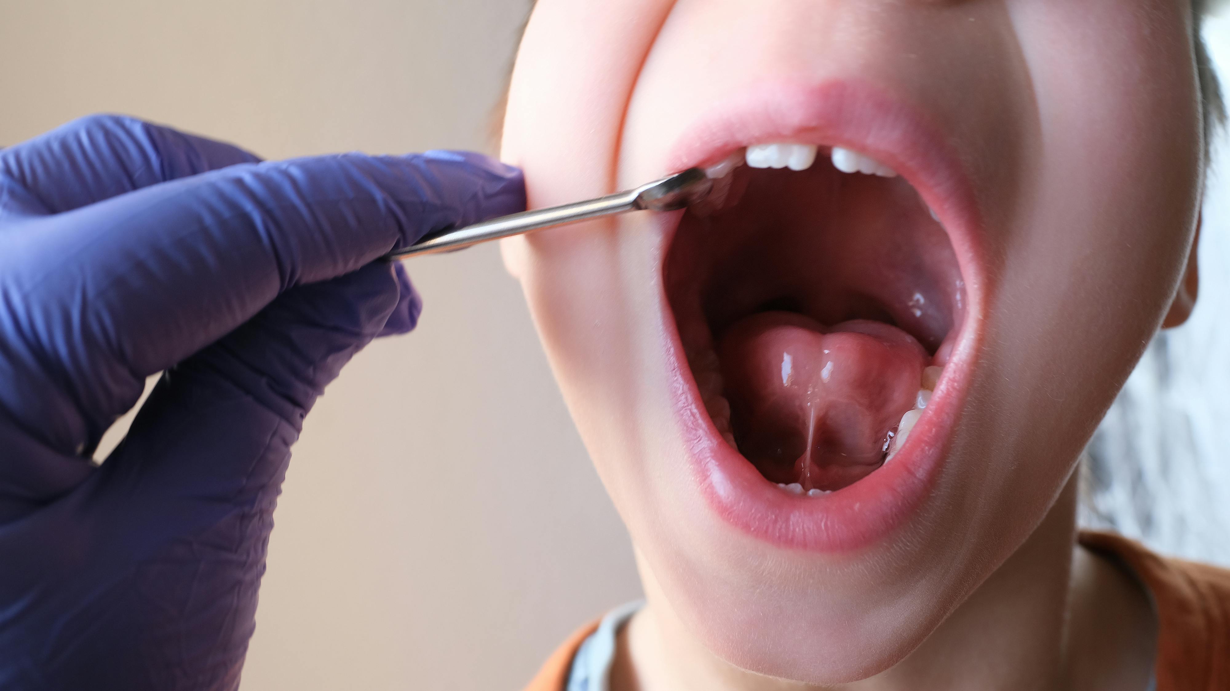 tongue-tie / ankyloslossia