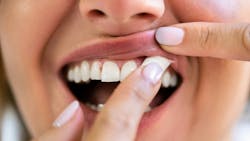 woman-placing-nicotine-pouch-between-gums woman-placing-nicotine-pouch-between-gums