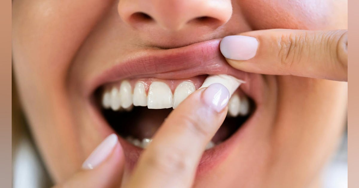 The latest oral health threat: Nicotine pouches The latest oral health threat: Nicotine pouches