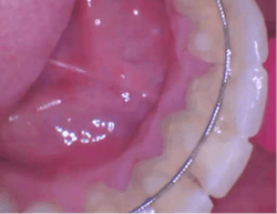 Figure 1: Supragingival calculus and a lower lingual retainer Figure 1: Supragingival calculus and a lower lingual retainer