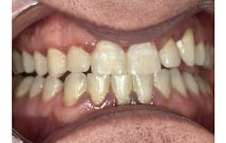 Figure 2: Bulbous and dark tissue, with severe generalized erythemic tissue and distended tissue in the upper and lower anterior regions Figure 2: Bulbous and dark tissue, with severe generalized erythemic tissue and distended tissue in the upper and lower anterior regions