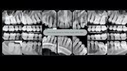 Figure 3: Full-mouth series reveals vertical bone loss, radiographic calculus, localized widened periodontal ligament spaces Figure 3: Full-mouth series reveals vertical bone loss, radiographic calculus, localized widened periodontal ligament spaces