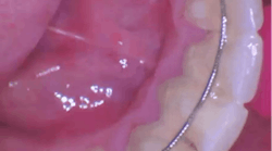 photo of a retainer on the bottom teeth photo of a retainer on the bottom teeth