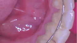 photo of a retainer on the bottom teeth photo of a retainer on the bottom teeth