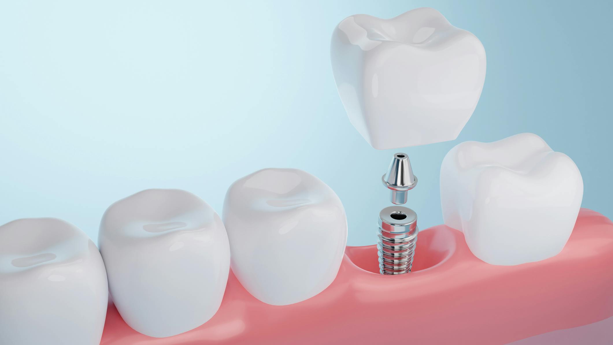 dental hygienists are being trained better in dental implant maintenance but more training is needed