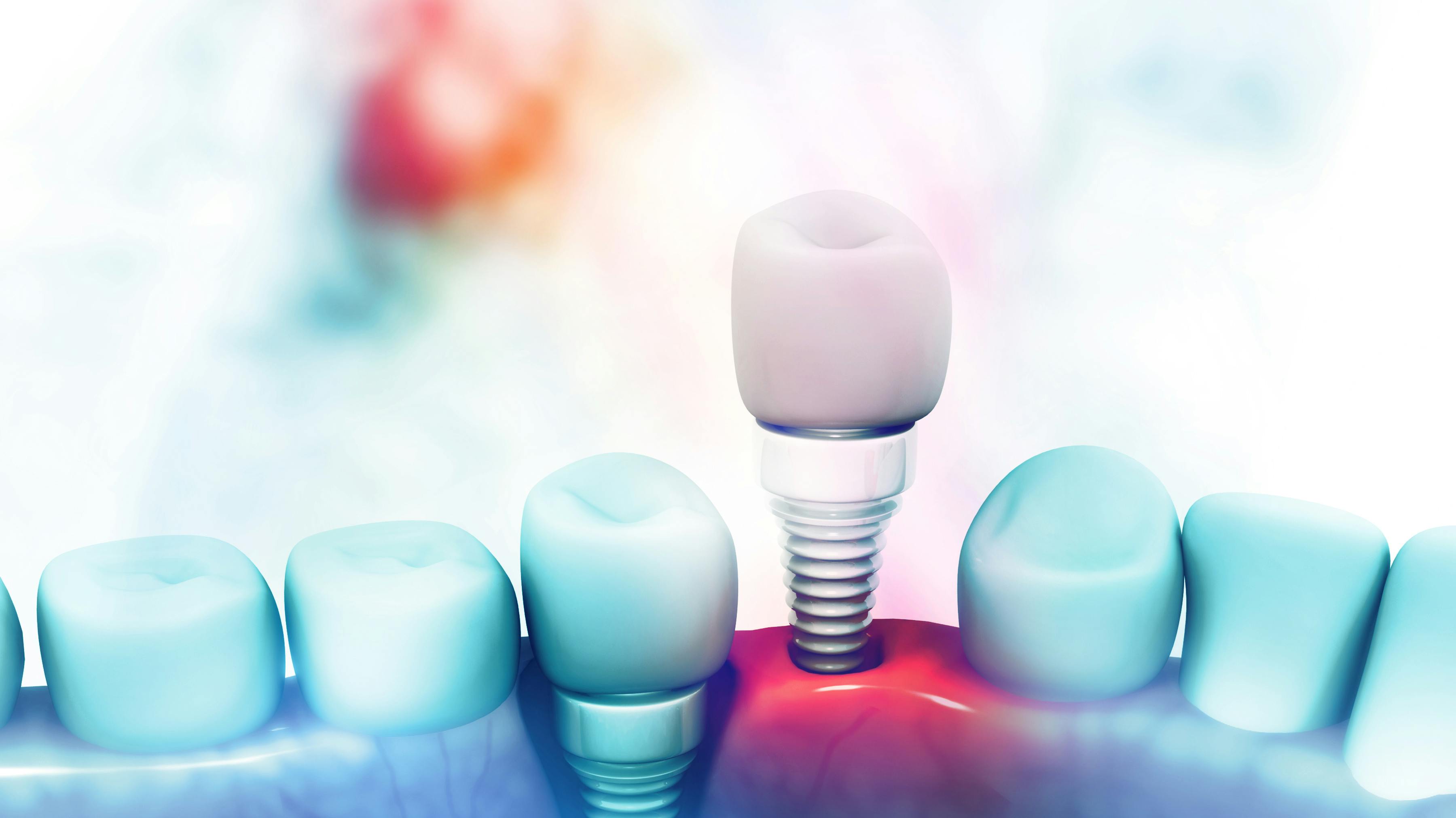 a dental implant