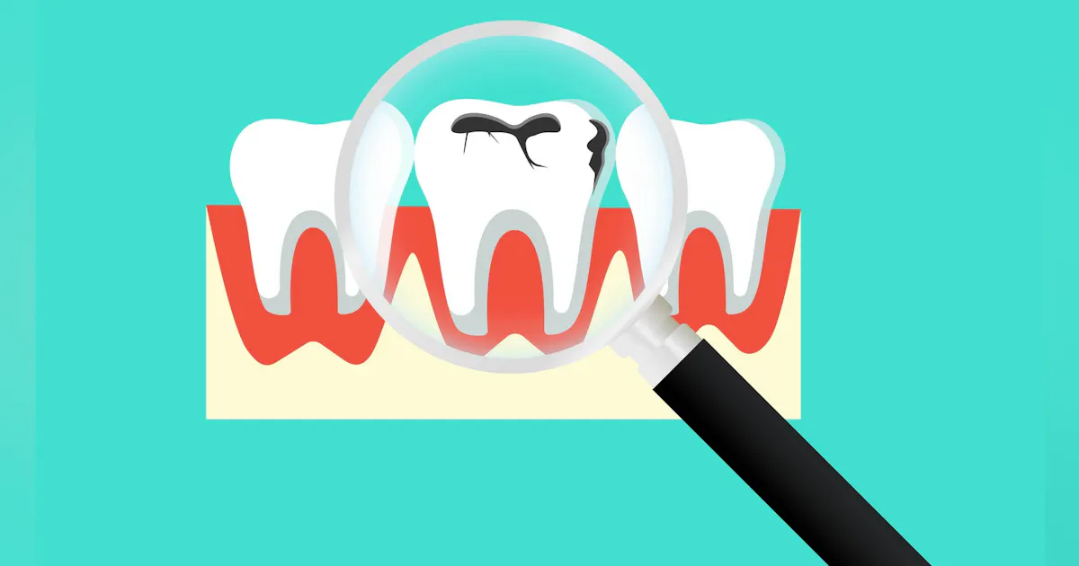 Rethinking caries detection: Preserving enamel to prevent the restorative cycle Rethinking caries detection: Preserving enamel to prevent the restorative cycle