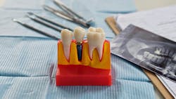 dental implants dental implants