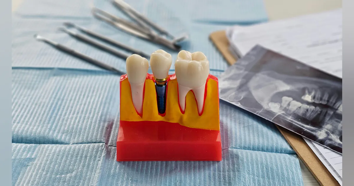 Implant maintenance update | Registered Dental Hygienists Implant maintenance update | Registered Dental Hygienists