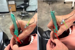 Figure 2: Scaling using adaptive (left) and rigid (right) curettes with pressure sensors (red arrow) positioned underneath the sheath. Both curettes appear green because of the green sheath holding the sensors in place. One sEMG sensor is visible (green arrow); the remaining three are not visible. Figure 2: Scaling using adaptive (left) and rigid (right) curettes with pressure sensors (red arrow) positioned underneath the sheath. Both curettes appear green because of the green sheath holding the sensors in place. One sEMG sensor is visible (green arrow); the remaining three are not visible.