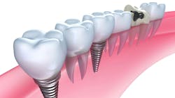 This survey revealed that dental hygienists are in need of education in dental implant maintenance. This survey revealed that dental hygienists are in need of education in dental implant maintenance.