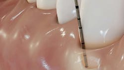 probing a dental gum probing a dental gum