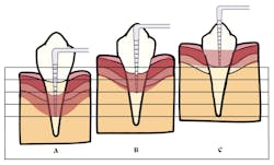 chart of dental pocket depth chart of dental pocket depth