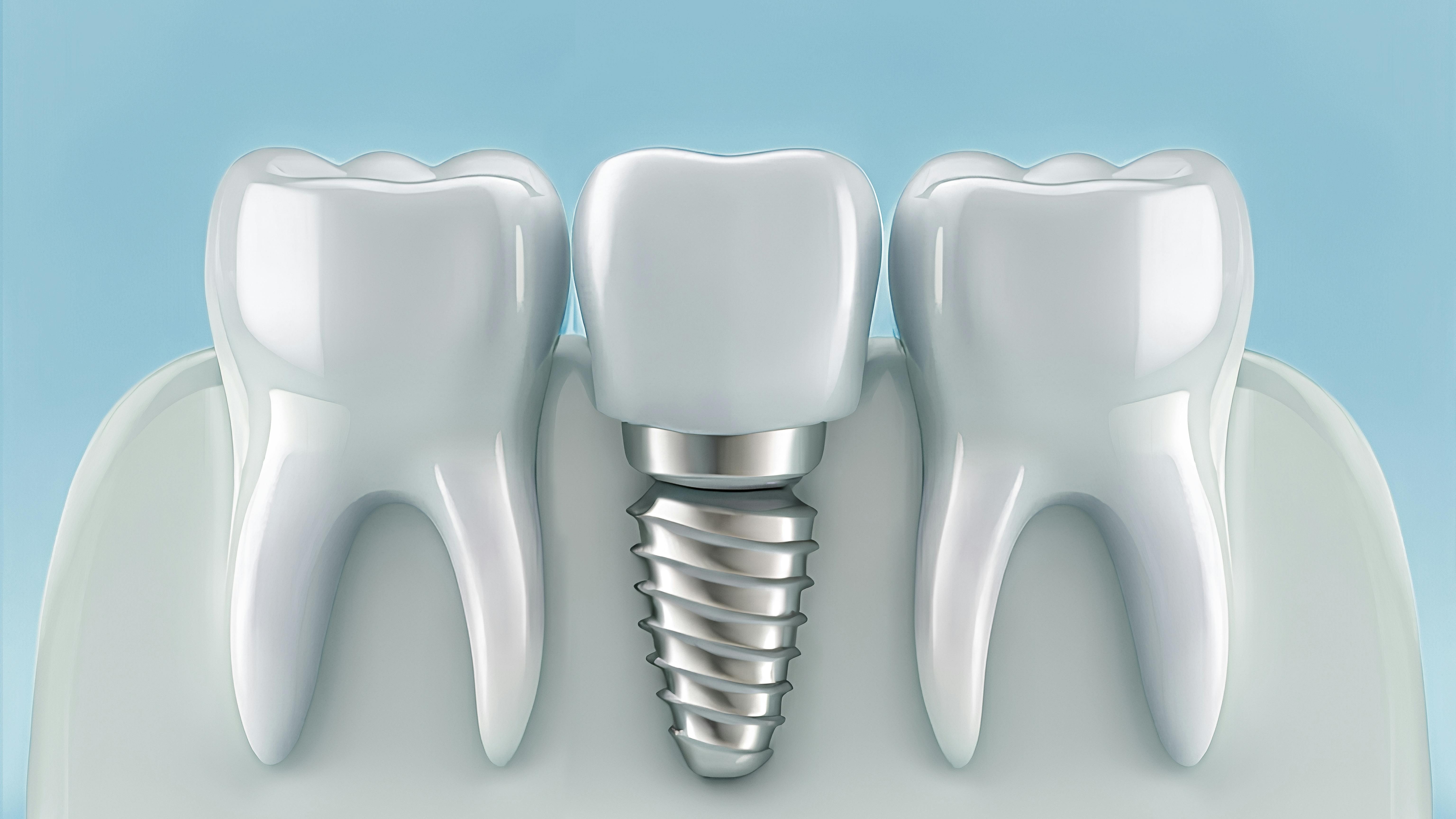 Hygienists can help protect dental implant longevity.
