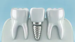 Hygienists can help protect dental implant longevity.