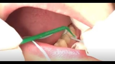 Silver Diamine Fluoride Placement INTERPROXIMAL