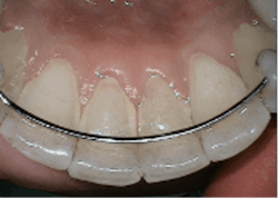 Figure 1: Mandibular anterior teeth with lingual fixed retainer and crowding Figure 1: Mandibular anterior teeth with lingual fixed retainer and crowding