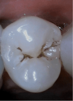 Sodium bicarbonate powder removed stains prior to sealant placement. Sodium bicarbonate powder removed stains prior to sealant placement.