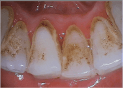 Glycine powder removed immature calculus, stains, and all biofilm on both enamel and dentin. Piezo removed firmly established calculus. Glycine powder removed immature calculus, stains, and all biofilm on both enamel and dentin. Piezo removed firmly established calculus.