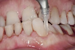 Figure 2: Subgingival nozzle in deep periodontal pocket Figure 2: Subgingival nozzle in deep periodontal pocket