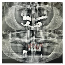 Figure 1: This radiographic timeline spans five years, marking a gradual yet inevitable shift toward complete tooth loss. For the provider, each failed effort to preserve dentition brings frustration and a sense of helplessness. For the patient, the experience is often tied to grief, mourning their teeth as they would any lost part of themselves. Figure 1: This radiographic timeline spans five years, marking a gradual yet inevitable shift toward complete tooth loss. For the provider, each failed effort to preserve dentition brings frustration and a sense of helplessness. For the patient, the experience is often tied to grief, mourning their teeth as they would any lost part of themselves.