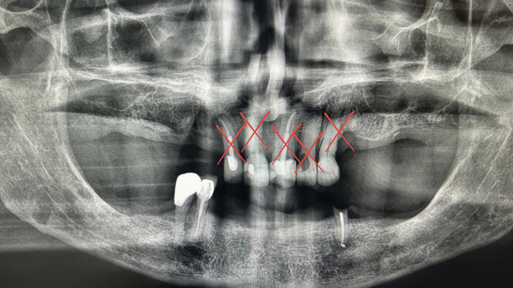 edentulous dental patient