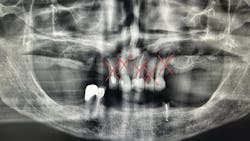 edentulous dental patient edentulous dental patient