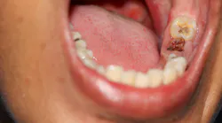 Teeth with cavities