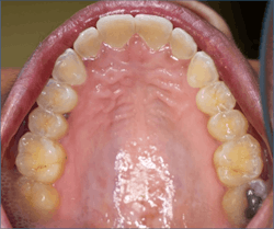Figure 1: Dental erosion periomolysis Figure 1: Dental erosion periomolysis